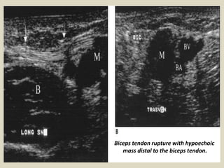 Biceps tendon rupture with hypoechoic
mass distal to the biceps tendon.
 