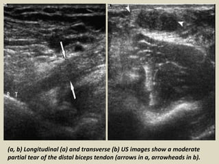 (a, b) Longitudinal (a) and transverse (b) US images show a moderate
partial tear of the distal biceps tendon (arrows in a, arrowheads in b).
 