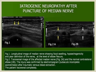 Presentation1.pptx, ultrasound examination of the elbow joint.