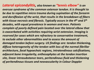 Lateral epicondylitis, also known as “tennis elbow” is an
overuse syndrome of the common extensor tendon. It is thought to
be due to repetitive micro trauma during supination of the forearm
and dorsiflexion of the wrist, that results in the breakdown of fibers
with tissue necrosis and fibrosis. Typically occurs in the 4th and 5th
decades, with equal prevalence in women and men. Patients
complain of poorly defined pain located over the lateral elbow that
is exacerbated with activities requiring wrist extension. Imaging is
reserved for cases which are refractory to conservative treatment,
to exclude other abnormalities and to assess the amount of
damaged tendon before surgery. US findings are: tendon thickening,
diffuse heterogeneity of the tendon with loss of the normal fibrillar
architecture, focal hypoechoic regions, intratendinous calcifications,
adjacent bone irregularity, enthesophytes at the tendon insertion
site, linear intrasubstance tears, peritendinous fluid and thickening
of peritendinous tissues and neovascularity in Colour Doppler
 
