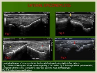 Presentation1.pptx, ultrasound examination of the elbow joint.