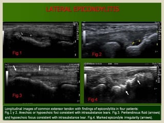 Presentation1.pptx, ultrasound examination of the elbow joint.