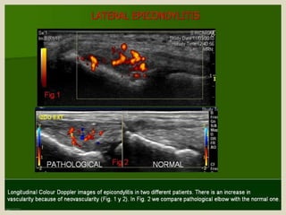 Presentation1.pptx, ultrasound examination of the elbow joint.