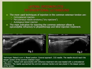 Presentation1.pptx, ultrasound examination of the elbow joint.