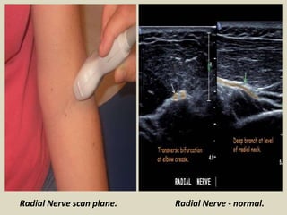 Radial Nerve scan plane. Radial Nerve - normal.
 
