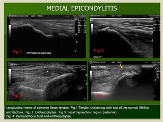 Presentation1.pptx, ultrasound examination of the elbow joint.