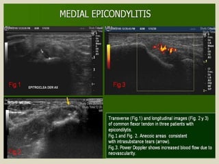 Presentation1.pptx, ultrasound examination of the elbow joint.