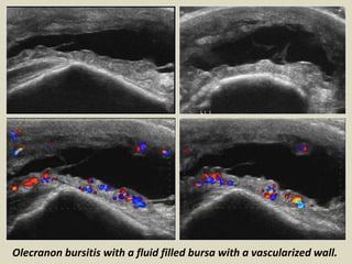 Olecranon bursitis with a fluid filled bursa with a vascularized wall.
 