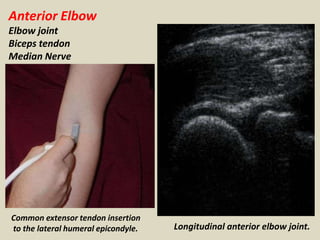 Anterior Elbow
Elbow joint
Biceps tendon
Median Nerve
Common extensor tendon insertion
to the lateral humeral epicondyle. Longitudinal anterior elbow joint.
 