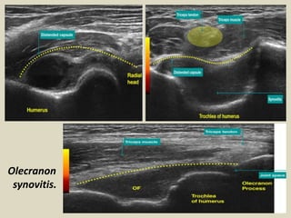 Olecranon
synovitis.
 