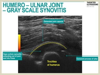 Presentation1.pptx, ultrasound examination of the elbow joint.