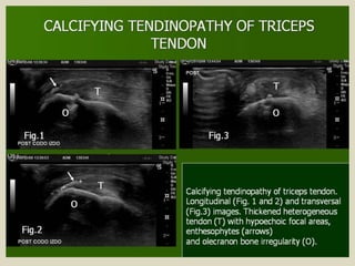 Presentation1.pptx, ultrasound examination of the elbow joint.