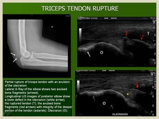 Presentation1.pptx, ultrasound examination of the elbow joint.