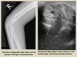 Ultrasound right elbow. Arrow denotes 7 mm
avulsion gap and triceps avulsion fracture.
Plain film radiography right elbow. Arrow
denotes ‘sail sign’ or hemoarthrosis.
 