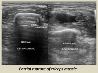Partial rupture of triceps muscle.
 