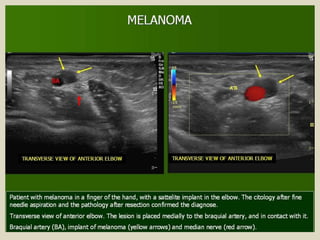 Presentation1.pptx, ultrasound examination of the elbow joint.