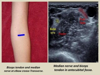 Biceps tendon and median
nerve at elbow crease-Transverse.
Median nerve and biceps
tendon in antecubital fossa.
 