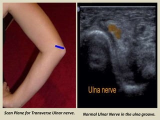 Scan Plane for Transverse Ulnar nerve. Normal Ulnar Nerve in the ulna groove.
 