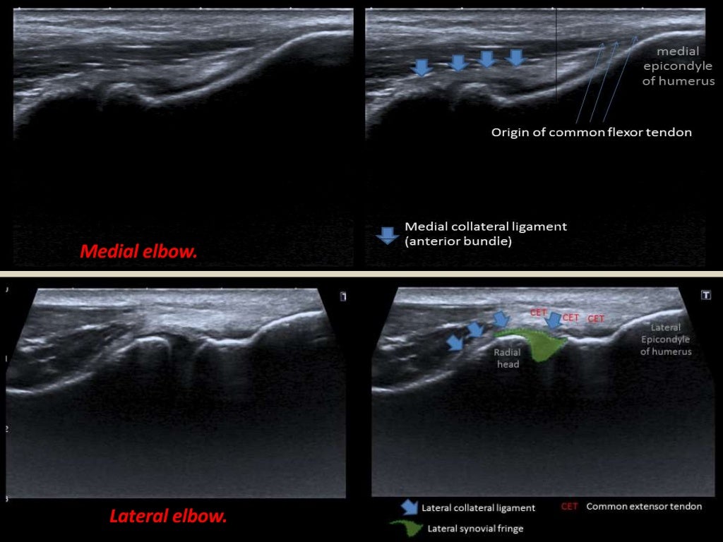 Presentation1.pptx, ultrasound examination of the elbow joint.