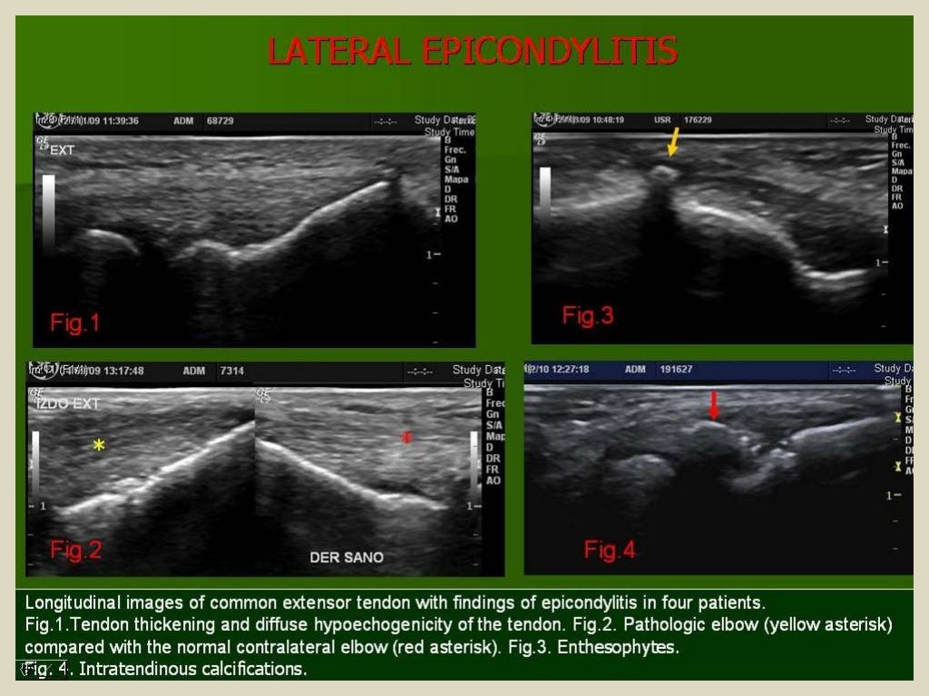 Presentation1.pptx, ultrasound examination of the elbow joint.