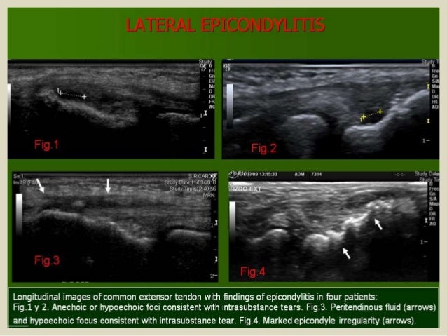 Presentation1.pptx, ultrasound examination of the elbow joint.
