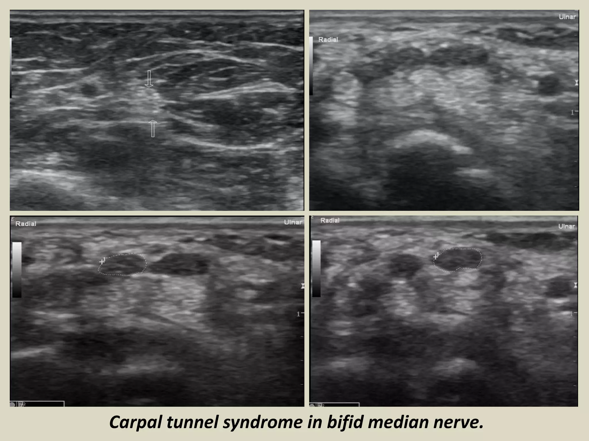 Carpal tunnel syndrome in bifid median nerve.
 