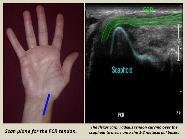 Ultrasound Examination Of The Wrist Joint