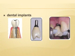  dental implants
 