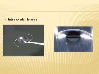  Intra ocular lenses
 