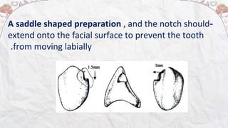 Rest and Rest Seat preparation..removable partial denture | PPT