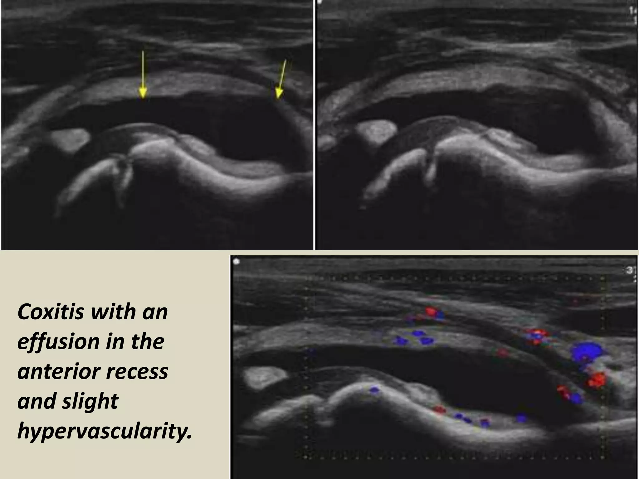Presentation1.pptx, ultrasound examination of the hip joint | PPTX