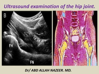 Ultrasound examination of the hip joint.
Dr/ ABD ALLAH NAZEER. MD.
 