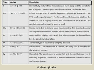 Graff Classification Presentation1.pptx, ultrasound examination of the hip joint | PPTX