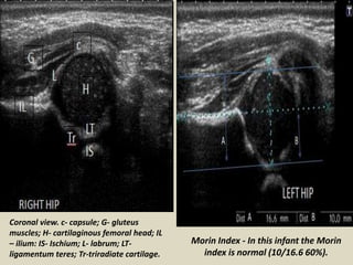 Presentation1.pptx, ultrasound examination of the hip joint