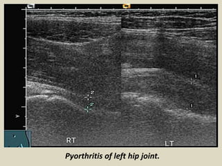 Presentation1.pptx, ultrasound examination of the hip joint