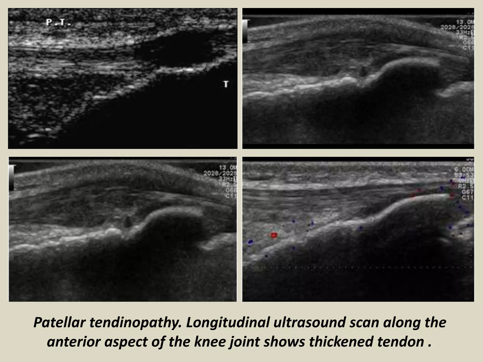 Presentation1.pptx, ultrasound examination of the knee joint. | PPTX