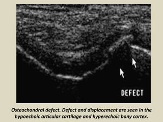 Presentation1.pptx, ultrasound examination of the knee joint. | PPTX