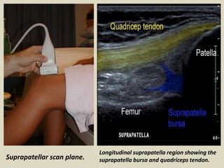 Suprapatellar scan plane.
Longitudinal suprapatella region showing the
suprapatella bursa and quadriceps tendon.
 