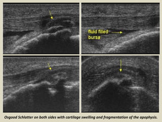 Medial meniscal tear: (a) Coronal T1-weighted magnetic resonance imaging, (b) ultrasound
 