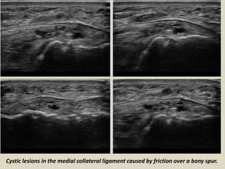 Magnetic resonance imaging and
sonographic images of an individual with
a ruptured left anterior cruciate ligament
(ACL). ...