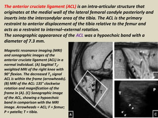 Degenerative arthritis. Transverse ultrasound scan of the flexed knee shows loss of
the normal hypoechoic pattern of the a...