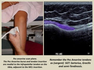 Pes anserine scan plane.
The Pes Anserine bursa and tendon insertion
are medial to the Infrapatellar tendon on the
tibia, ...