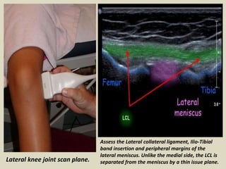 Lateral knee joint scan plane.
Assess the Lateral collateral ligament, Ilio-Tibial
band insertion and peripheral margins o...