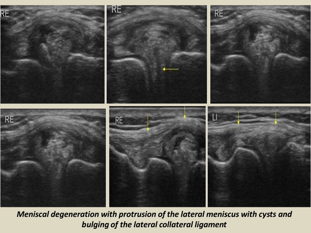 Presentation1.pptx, ultrasound examination of the knee joint.