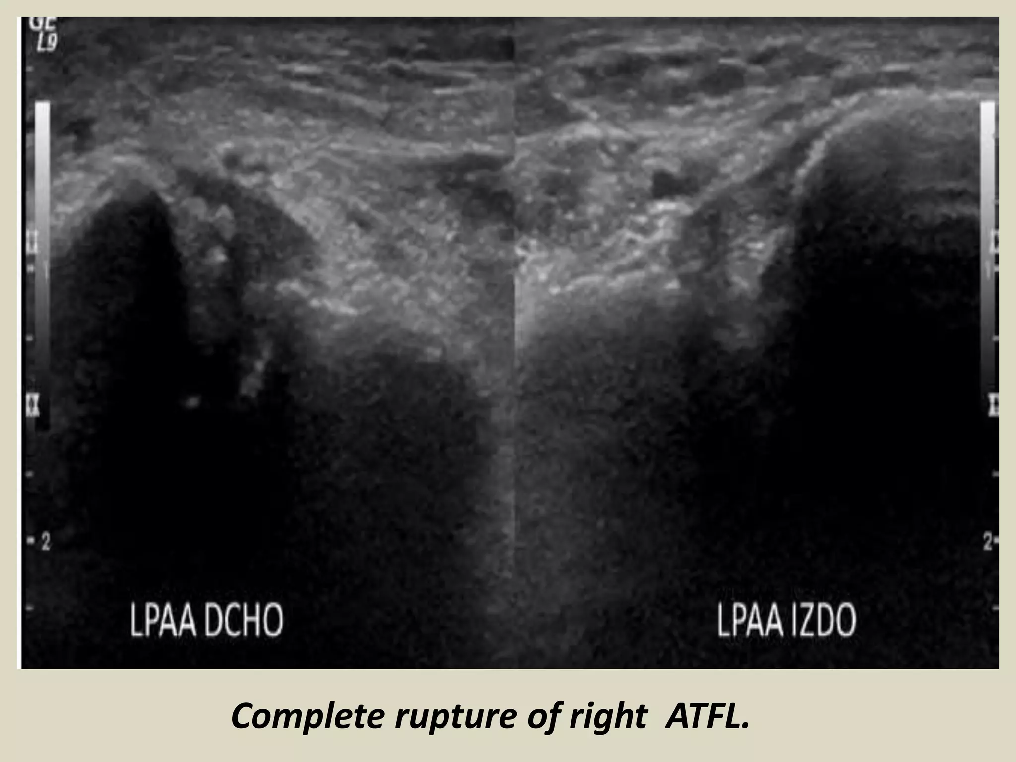 Presentation1.pptx. ultrasound examination of the ankle joint. | PPTX