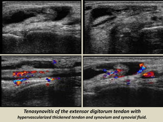 Presentation1.pptx. ultrasound examination of the ankle joint. | PPTX