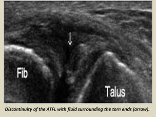 Presentation1.pptx. ultrasound examination of the ankle joint. | PPTX