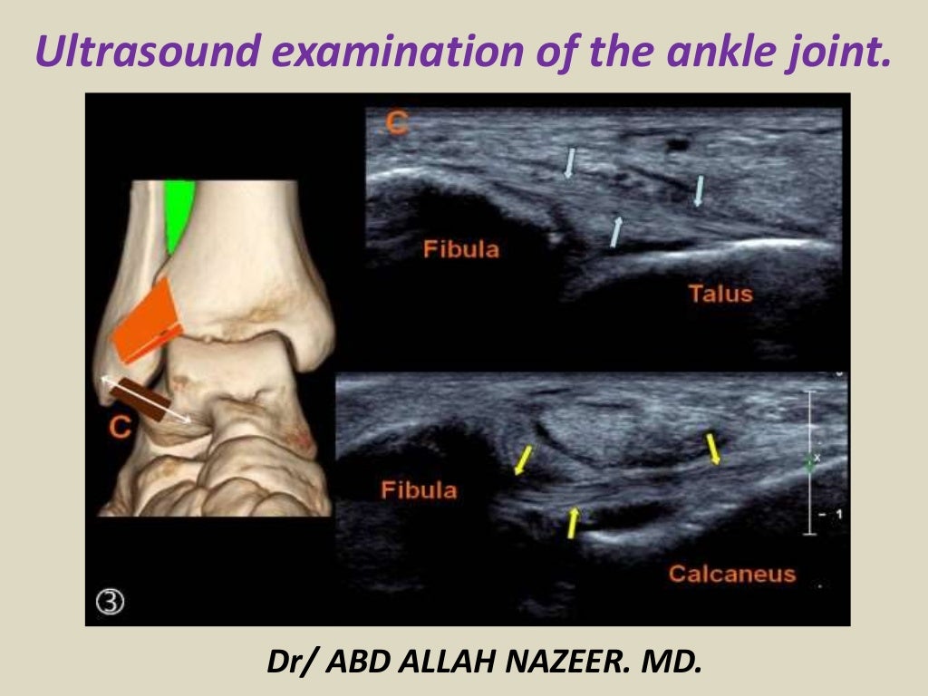Presentation1.pptx. ultrasound examination of the ankle joint.