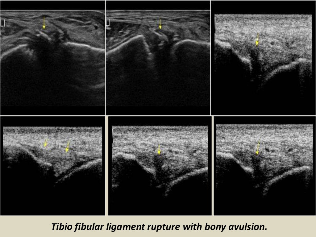 Presentation1.pptx. ultrasound examination of the ankle joint.