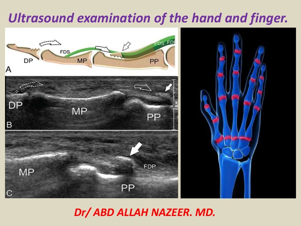Presentation1.pptx, ultrasound of the hand and fingers.